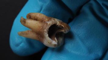 Tooth decay and dentist hand with glove and black background. Macro shot of a decayed teeth till root after extraction of dentist. Real tooth anatomy due lack of dental care. Top view of caries teeth photo