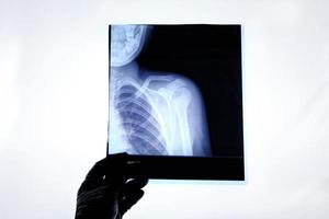X-ray image of a man with a broken collarbone. photo