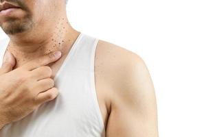 Middle aged man in white veat point to Skin Tags or Acrochordon on his neck photo