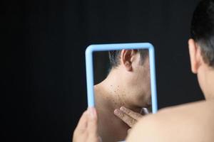 Asian middle man looks in the mirror and point to Skin Tags or Acrochordon on neck