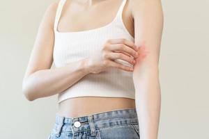 dermatología asiático joven mujer, niña alergia, alérgico reacción desde atópico, insecto picaduras en su brazo, mano en rascarse que produce picor, picar rojo Mancha o erupción de piel. cuidado de la salud, tratamiento de belleza. foto