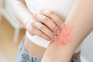 Dermatology asian young woman, girl allergy, allergic reaction from atopic, insect bites on her arm, hand in scratching itchy, itch red spot or rash of skin. Healthcare, treatment of beauty. photo