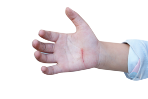 wound on a child's hand png