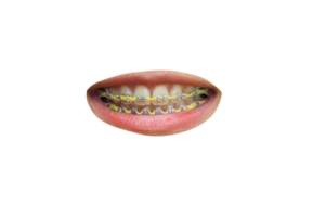 bouche avec un appareil dentaire png