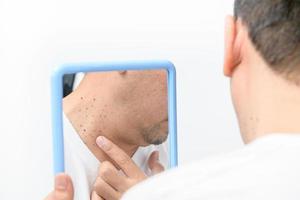 Asian middle man looks in the mirror and point to Skin Tags or Acrochordon on neck photo