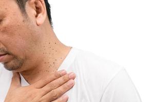 Closed up the Skin Tags or Acrochordon on neck man isolated on white photo