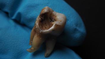 Tooth decay and dentist hand with glove and black background. Macro shot of a decayed teeth till root after extraction of dentist. Real tooth anatomy due lack of dental care. Top view of caries teeth photo