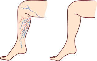 Patient legs with varicose veins png