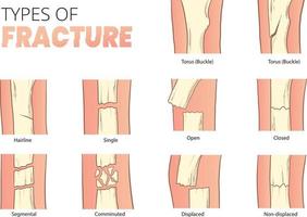 tipos de huesos fractura vector