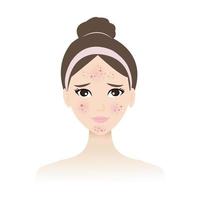 The woman face with skin acne vector isolated on white background. Acne, pimples, blackheads, comedones, whiteheads, papule, pustule, nodule and cyst on face. Skin face problem concept illustration.