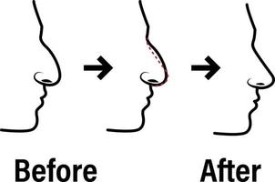 rinoplastia antes de y después el procedimiento infografía. nariz el plastico cirugía vector contorno concepto médico ilustración