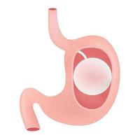 The gastric balloon. vector