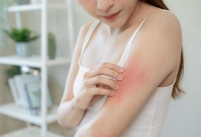 Dermatology, asian young woman, girl allergy, allergic reaction from atopic, insect bites on her arm, hand in scratching itchy, itch red spot or rash of skin. Healthcare, treatment of beauty. photo