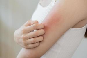 Dermatology, asian young woman, girl allergy, allergic reaction from atopic, insect bites on her arm, hand in scratching itchy, itch red spot or rash of skin. Healthcare, treatment of beauty. photo