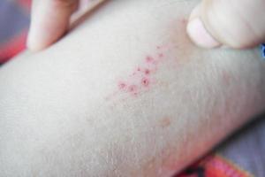 man suffering from itching skin, close up. photo