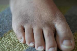 close up of women feet with swelling photo