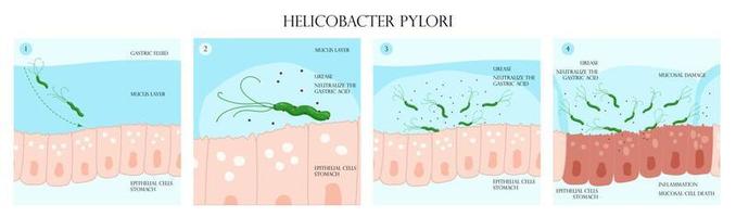 Helicobacter pylori infection process in stomach mucosal layer infographic vector