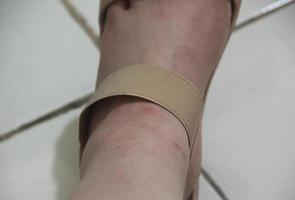 Women leg with brown shoes strap. Visible redness bump scar on skin, need to be treated with ointment. Isolated leg photo on white ceramic floor.