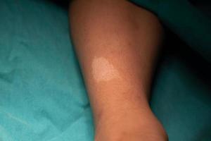 Hypomelanic macules on the leg in tuberous sclerosis patient. photo