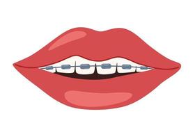 Mouth with braces on teeth. Installing braces. Correction of byte. Dentistry. Orthodontics. Installing braces. Metal braces. Straight teeth. Vector illustration