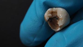 Tooth decay and dentist hand with glove and black background. Macro shot of a decayed teeth till root after extraction of dentist. Real tooth anatomy due lack of dental care. Top view of caries teeth photo