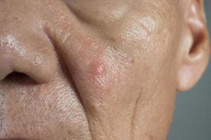 Close up of a Man with a big ugly pimple on his cheek photo