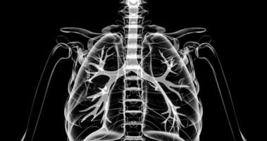 Lung disease. Inflammation of the lungs in humans. X-ray of a person on a black background. Illustration of tuberculosis, pneumonia, infection, coronavirus video