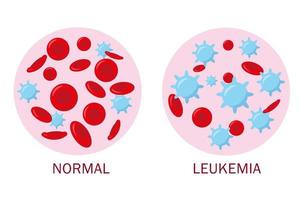 Normal blood and leukemia blood for medical concept. Blood analysis or leukemia test banner. Vector illustration.