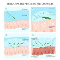 helicobacter pylori infección proceso en estómago mucosa capa ilustración vector