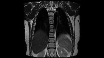 torace raggi X mri animazione. umano polmoni, il petto l'imaging video