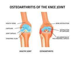 Knee Joint Ostheoarthritis Infographics vector