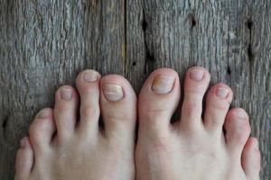 Close-up of legs with fungus on nails on wooden background. Onycholysis exfoliation of the nail from the nail bed photo