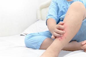 Hand scratching ,legs of fat boy with swelling spot photo