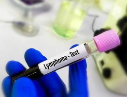 Blood sample for Lymphoma test. Hodgkin lymphoma, Non-Hodgkin lymphoma. Lymphoma is a cancer of lymphatic system. photo