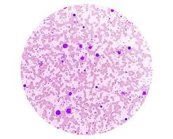 crónico mieloide leucemia en acelerado fase con trombocitosis. crónico mielógeno leucemia. foto