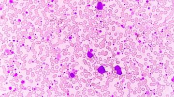 crónico mieloide leucemia o cml en acelerado fase con trombocitosis. crónico mielógeno leucemia. foto