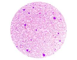 crónico mieloide leucemia o cml en acelerado fase con trombocitosis. crónico mielógeno leucemia. foto