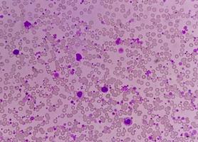 Chronic myeloid leukemia or CML in accelerated phase with thrombocytosis. Chronic myelogenous leukemia. photo