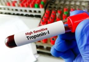 Scientist holding blood sample for High sensitive Troponin-I or hs Troponin-I, for the early diagnosis of myocardial infraction. photo