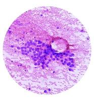 microfotografía de multa aguja aspiración citología de un pulmonar nódulo demostración adenocarcinoma, un tipo de no pequeño célula carcinoma. foto