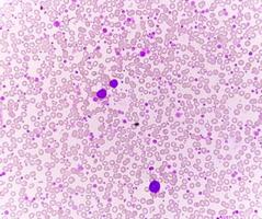 Chronic myeloid leukemia or CML in accelerated phase with thrombocytosis. Chronic myelogenous leukemia. photo