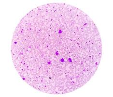 crónico mieloide leucemia o cml en acelerado fase con trombocitosis. crónico mielógeno leucemia. foto