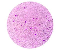 Chronic myeloid leukemia or CML in accelerated phase with thrombocytosis. Chronic myelogenous leukemia. photo