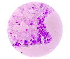 crónico mieloide leucemia o cml en acelerado fase con trombocitosis. crónico mielógeno leucemia. foto