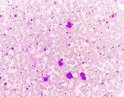 crónico mieloide leucemia o cml en acelerado fase con trombocitosis. crónico mielógeno leucemia. foto