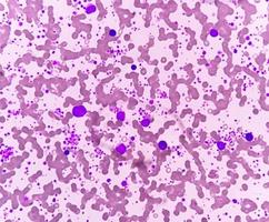 Chronic myeloid leukemia or CML in accelerated phase with thrombocytosis. Chronic myelogenous leukemia. photo