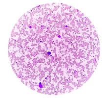 Chronic myeloid leukemia or CML in accelerated phase with thrombocytosis. Chronic myelogenous leukemia. photo