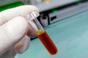 Scientist hold sample cup with icteric serum for test in laboratory. Hyperbilirubinemia, which can cause false laboratory test result. photo