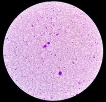 Chronic myeloid leukemia or CML in accelerated phase with thrombocytosis. Chronic myelogenous leukemia. photo