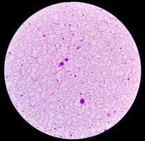 Chronic myeloid leukemia or CML in accelerated phase with thrombocytosis. Chronic myelogenous leukemia. photo